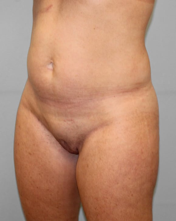 Before Image: SmartLipo- Dr. Howell - left-front-oblique