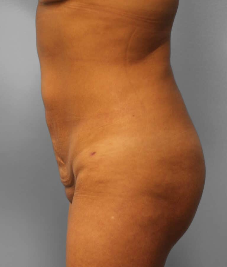 After Image: Lipo & BBL- Dr. Howell - left-side