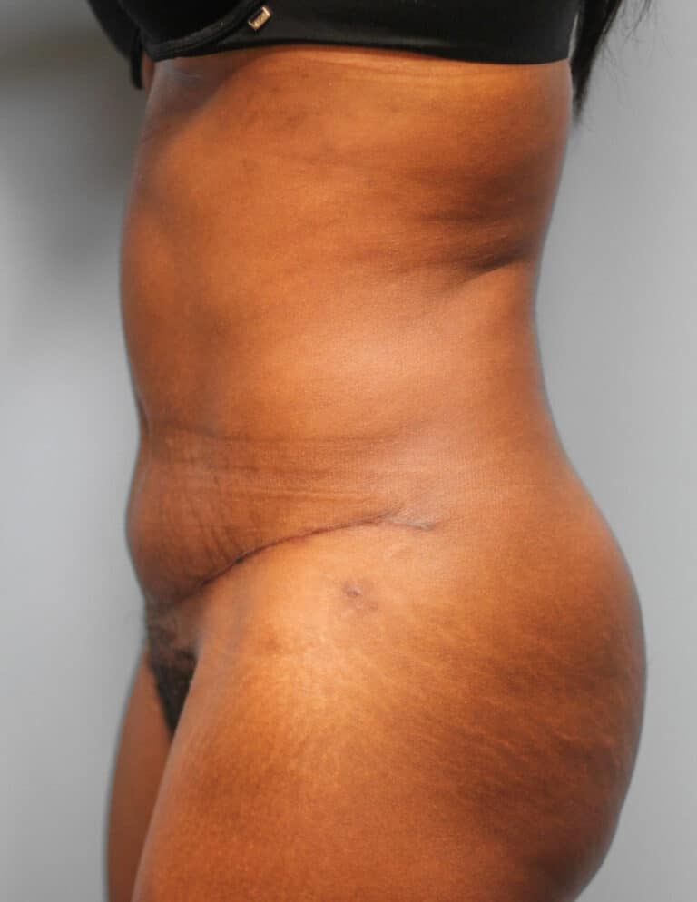 After Image: Abdominoplasty (Tummy Tuck) – Dr. Howell - left-side