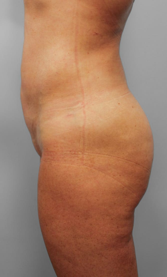 After Image: SmartLipo- Dr. Howell - left-side