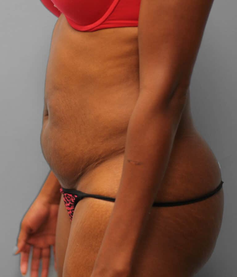 Before Image: Abdominoplasty (Tummy Tuck) – Dr. Howell - left-side