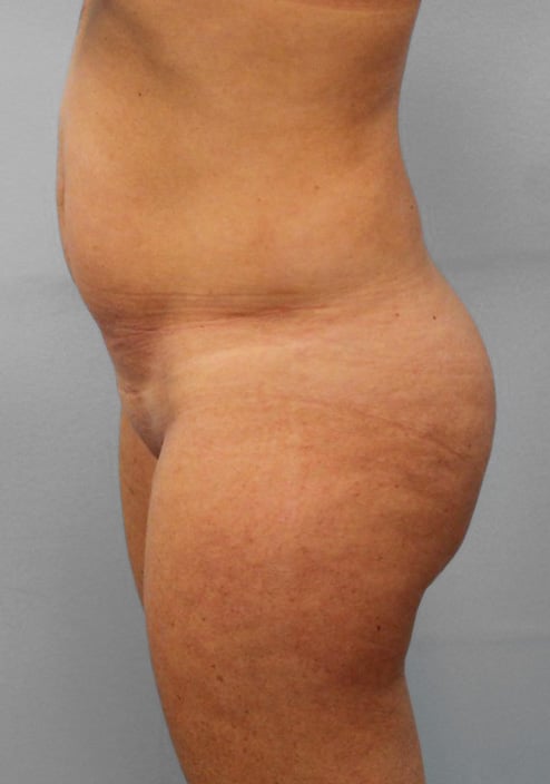 Before Image: SmartLipo- Dr. Howell - left-side