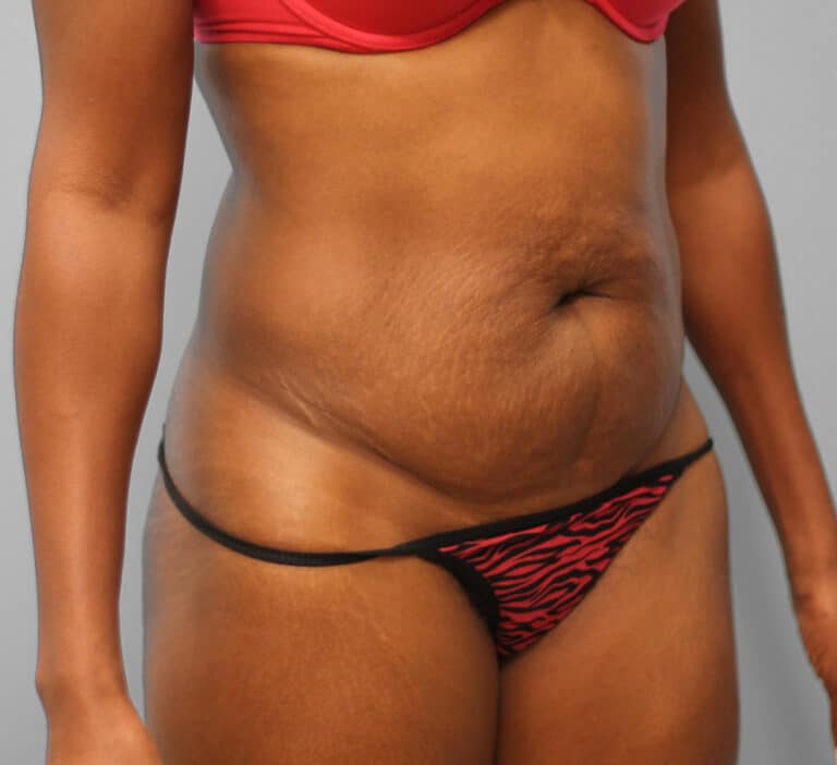 Before Image: Abdominoplasty (Tummy Tuck) – Dr. Howell - right-front-oblique