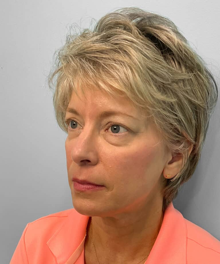 After Image: Juvéderm Voluma – Joy - left-front-oblique