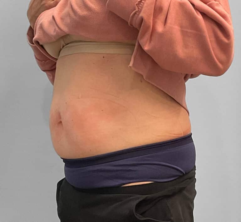 After Image: Emsculpt Neo- Jessica - left-front-oblique