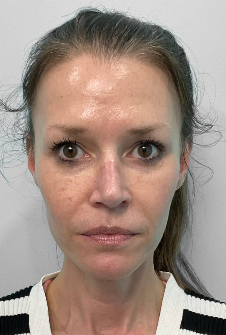 After Image: Juvéderm Vollure & Botox – Joy - front