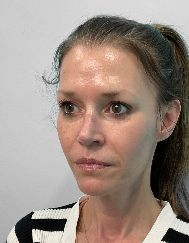 After Image: Juvéderm Vollure & Botox – Joy - left-front-oblique