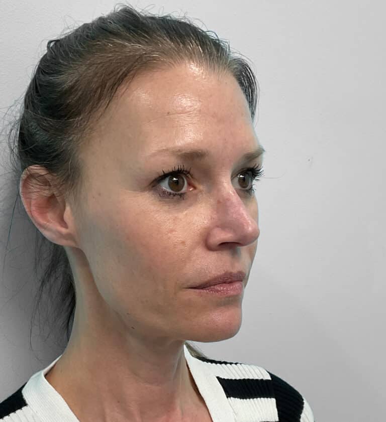 After Image: Juvéderm Vollure & Botox – Joy - right-front-oblique