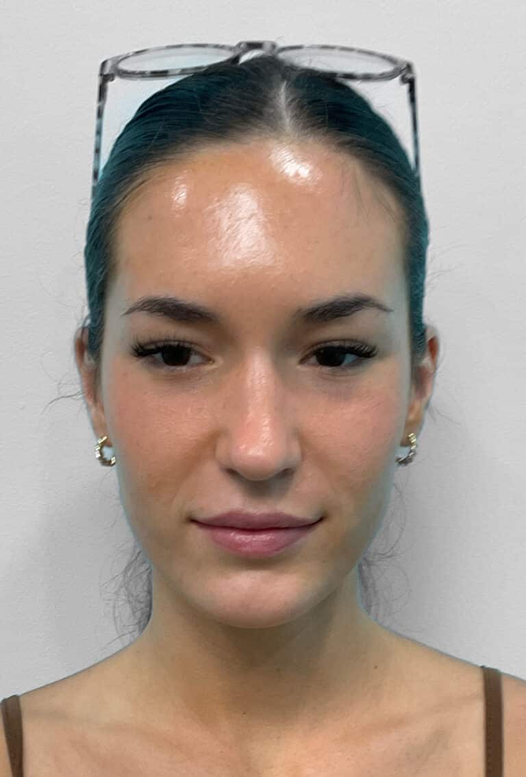 After Image: Juvéderm Vollure – Joy - front