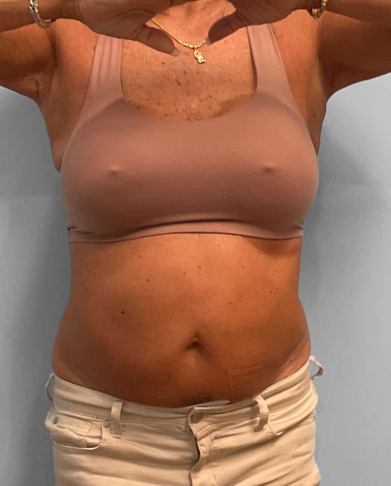 Before Image: Emsculpt Neo – Jessica - front