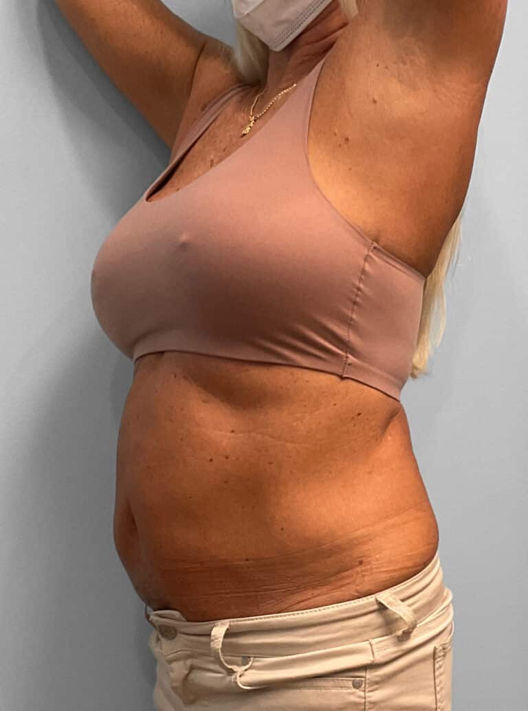 Before Image: Emsculpt Neo – Jessica - left-side