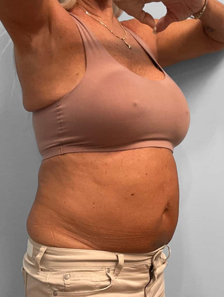 Before Image: Emsculpt Neo – Jessica - right-front-oblique