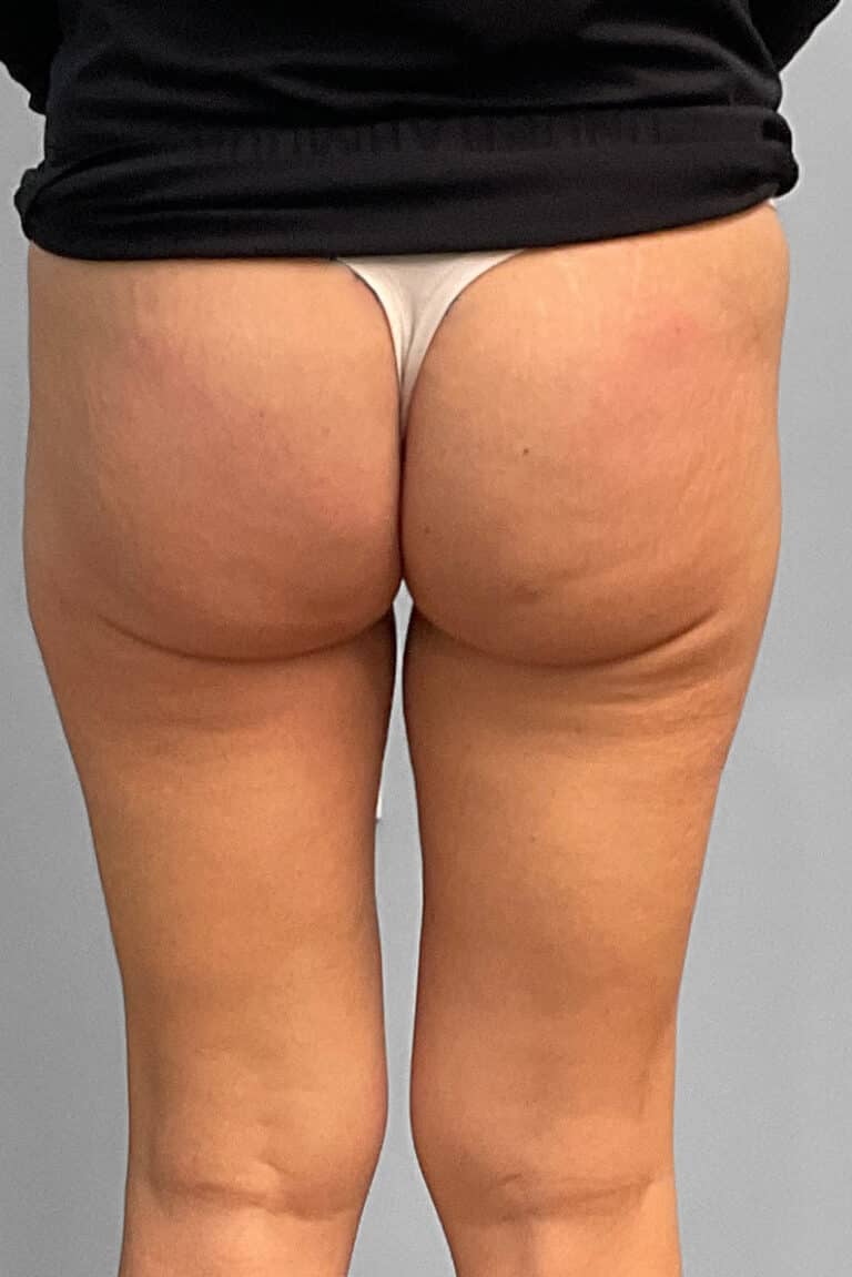 After Image: Emsculpt Neo – Jessica - back