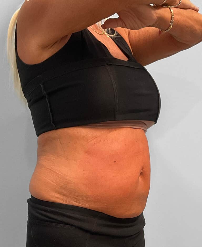 After Image: Emsculpt Neo – Jessica - right-front-oblique