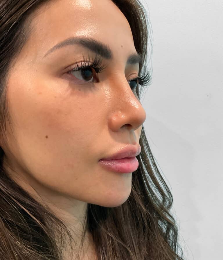 After Image: Juvéderm Volbella & Botox – Heather - right-front-oblique