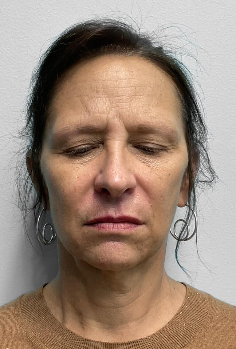 Before Image: Juvéderm & Botox – Joy - front