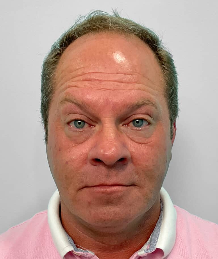 After Image: Botox – Joy - front