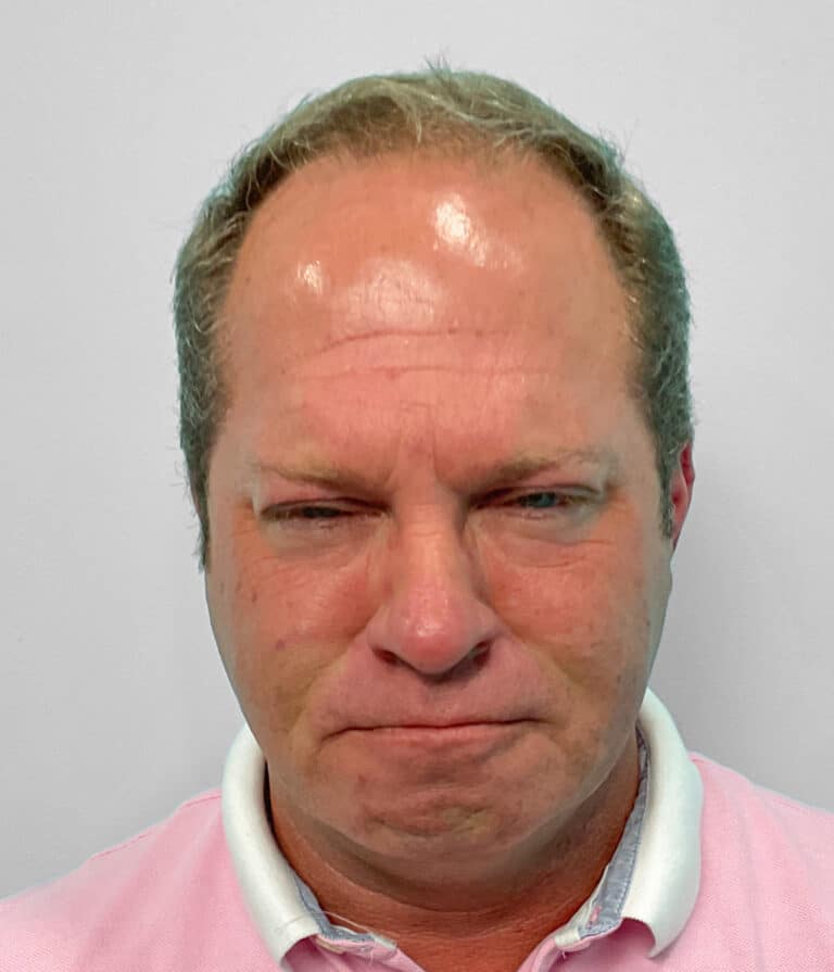 After Image: Botox – Joy - front