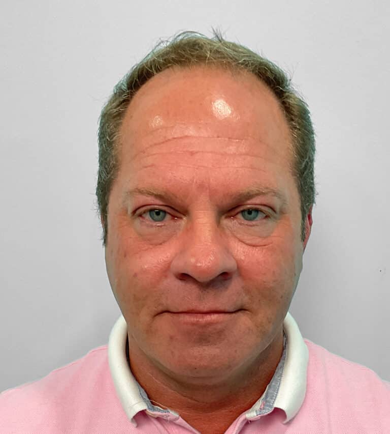 After Image: Botox – Joy - front