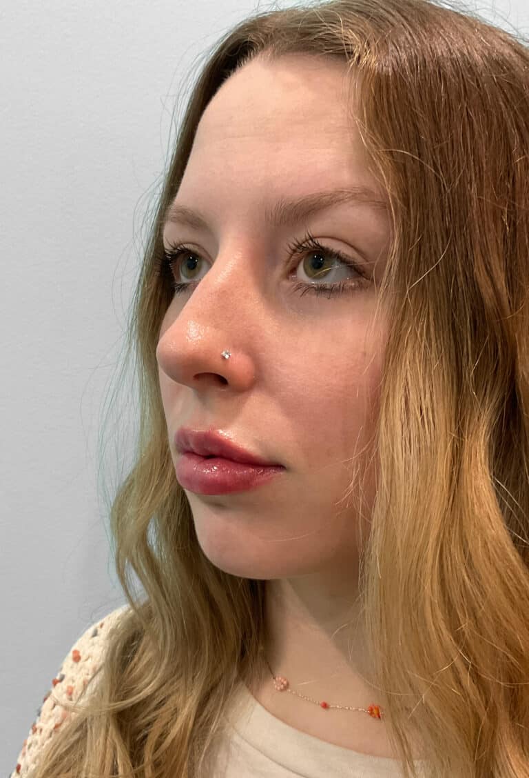 After Image: Juvéderm Ultra – Heather - left-front-oblique