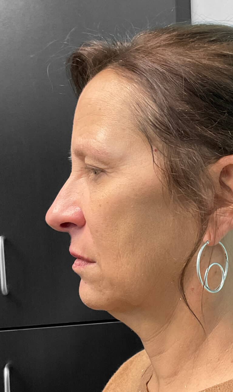 Before Image: Juvéderm & Botox – Joy - front