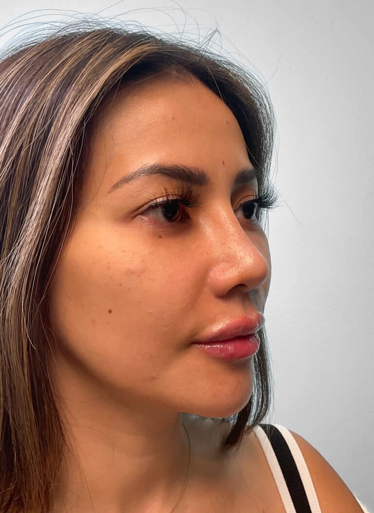 Before Image: Juvéderm Volbella & Botox – Heather - right-front-oblique