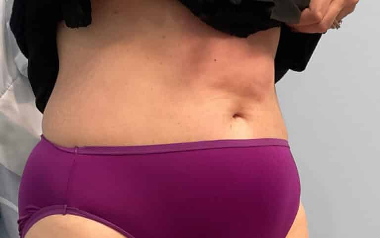 After Image: Emsculpt Neo – Jessica - right-front-oblique