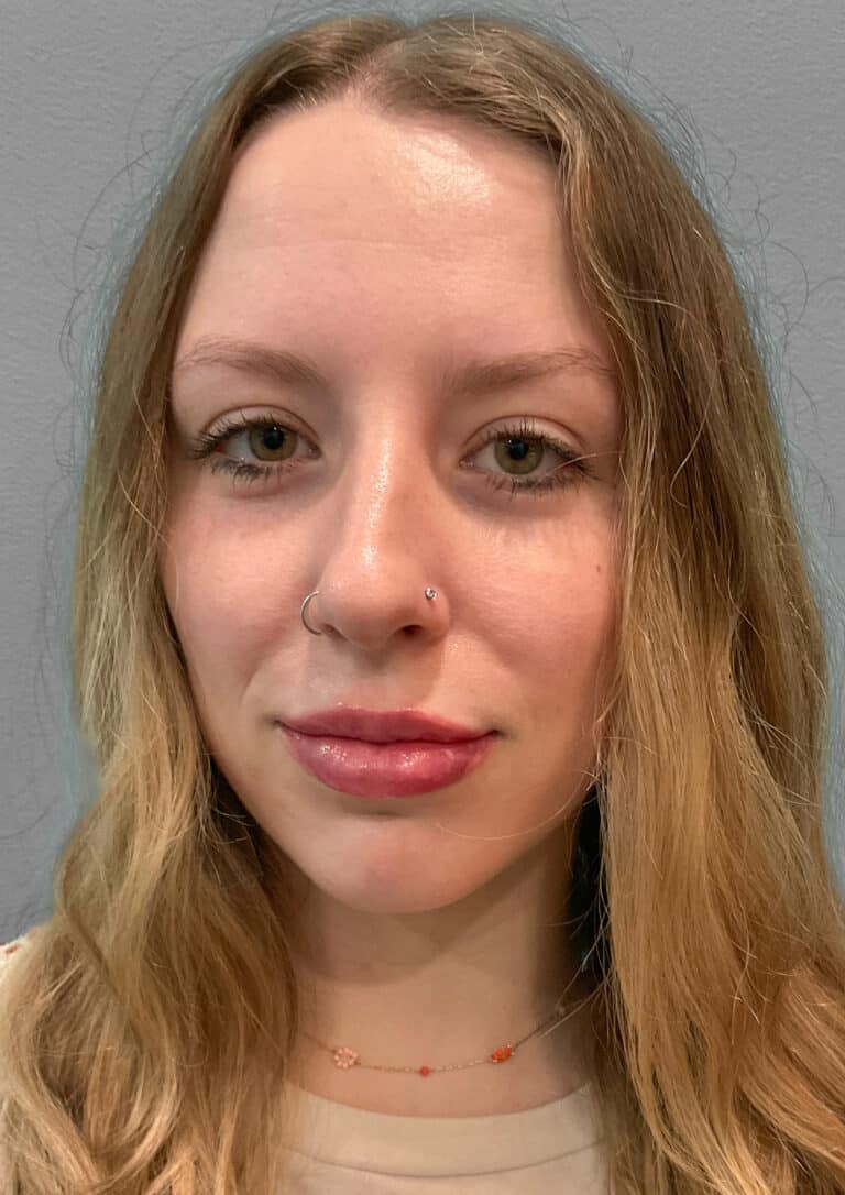 After Image: Juvéderm Ultra – Heather - front