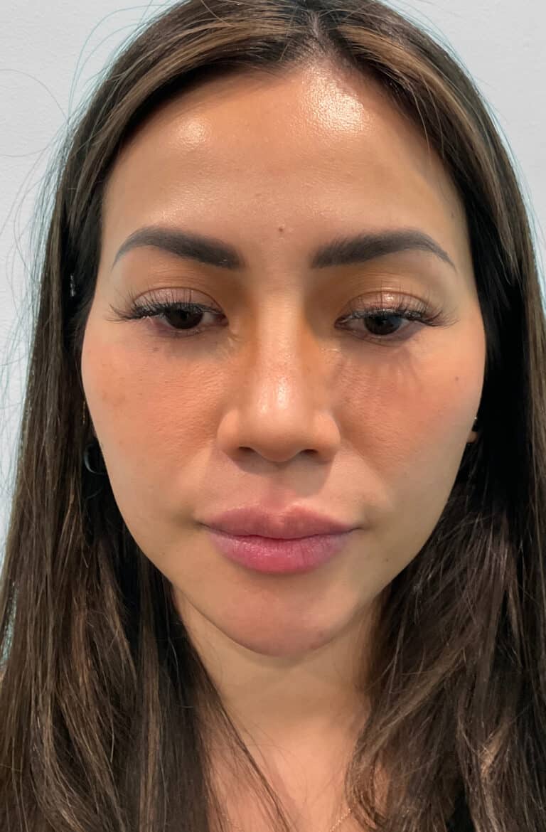 After Image: Juvéderm Volbella & Botox – Heather - front