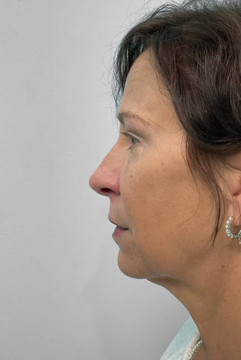 After Image: Juvéderm & Botox – Joy - front