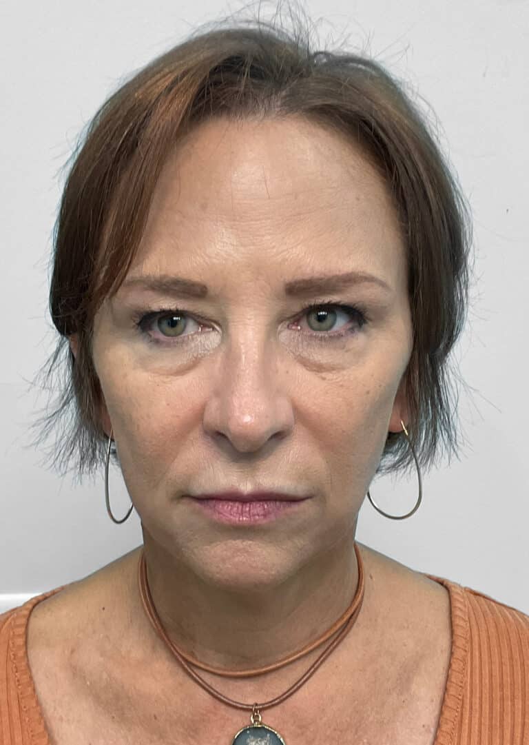 After Image: Juvéderm & Botox – Joy - front