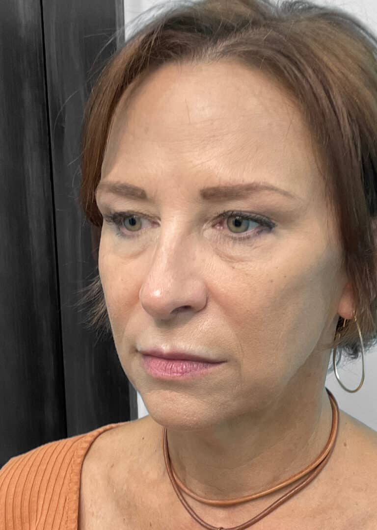 After Image: Juvéderm & Botox – Joy - left-front-oblique