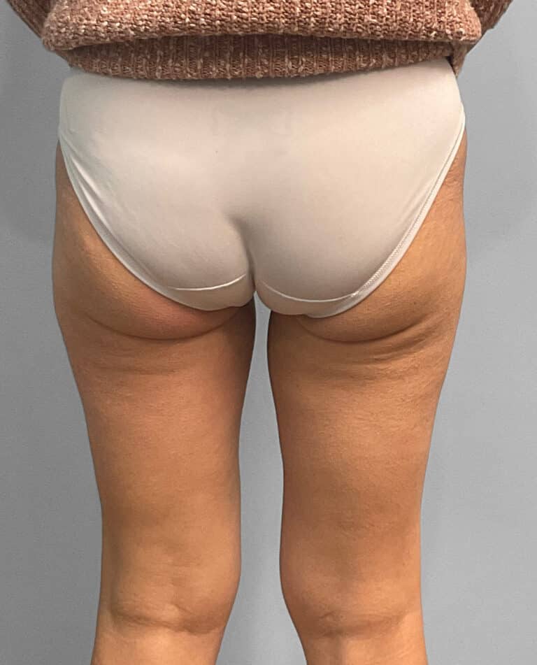 Before Image: Emsculpt Neo – Jessica - back