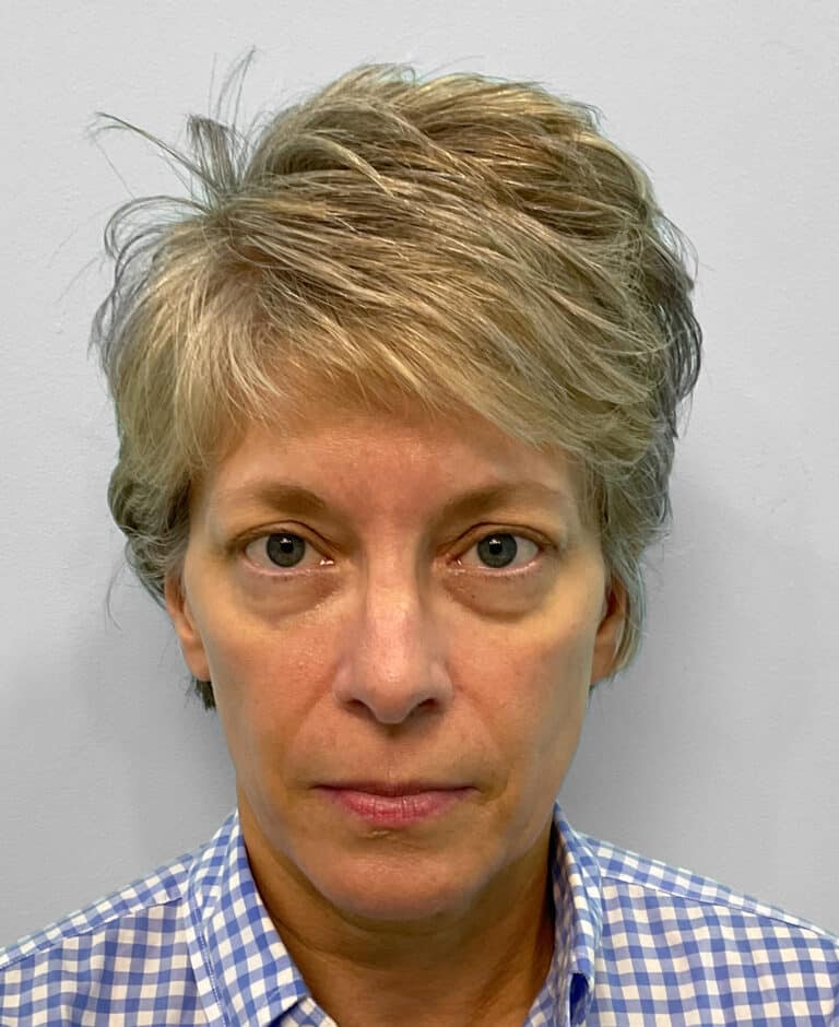 Before Image: Juvéderm Voluma – Joy - front