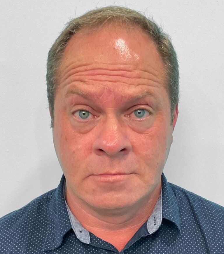 Before Image: Botox – Joy - front