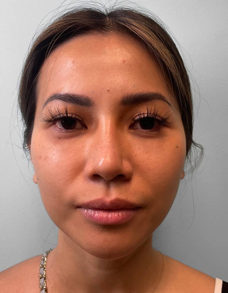 Before Image: Juvéderm Volbella & Botox – Heather - front