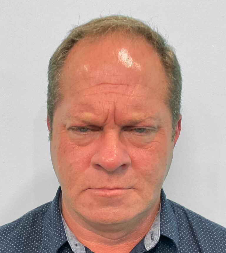 Before Image: Botox – Joy - front