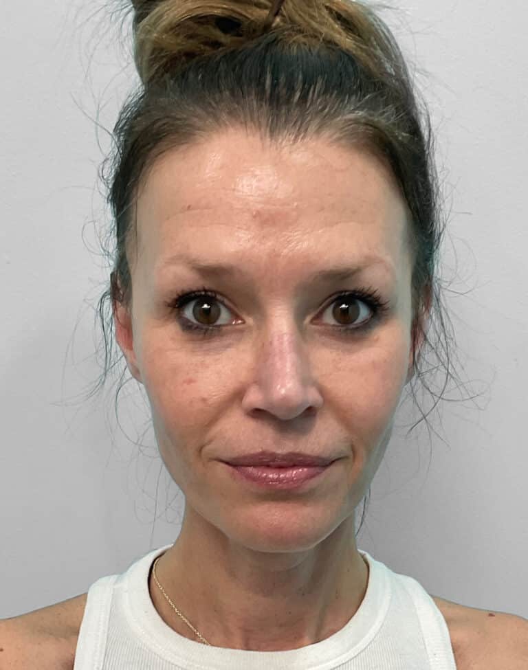 Before Image: Juvéderm Vollure & Botox – Joy - front