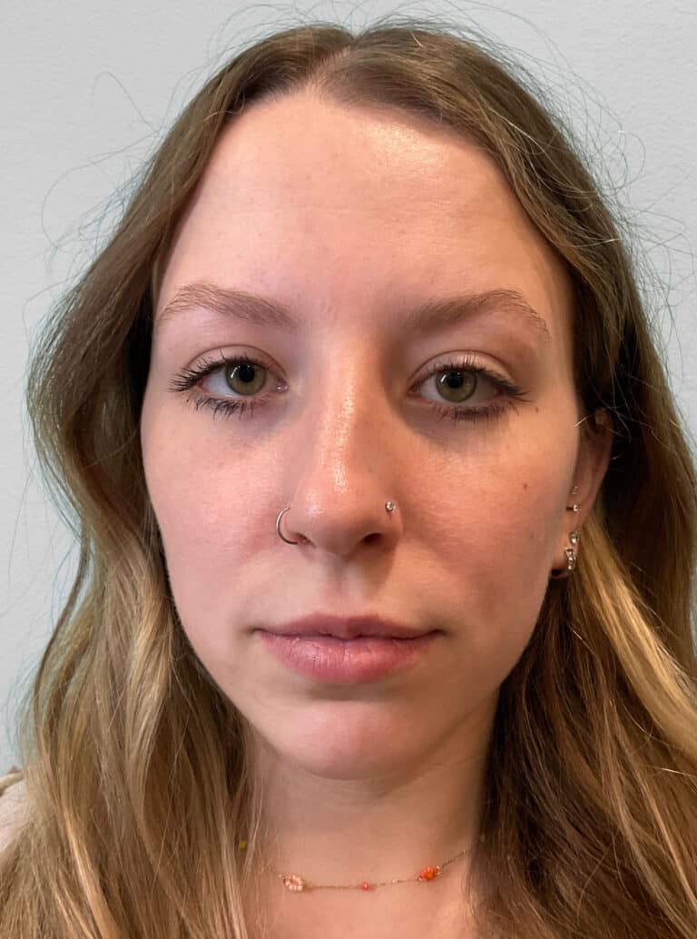 Before Image: Juvéderm Ultra – Heather - front