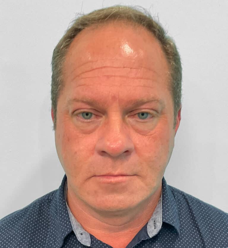 Before Image: Botox – Joy - front