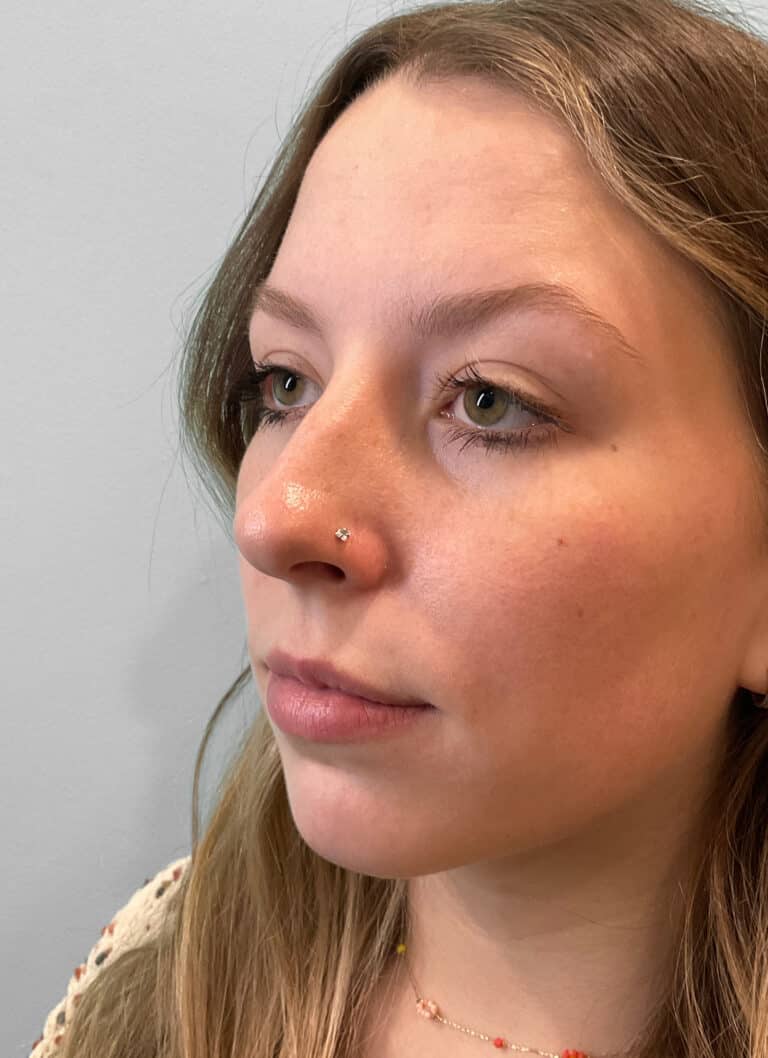 Before Image: Juvéderm Ultra – Heather - left-front-oblique