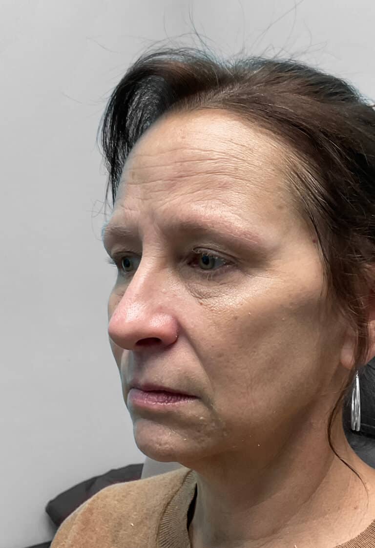 Before Image: Juvéderm & Botox – Joy - left-front-oblique