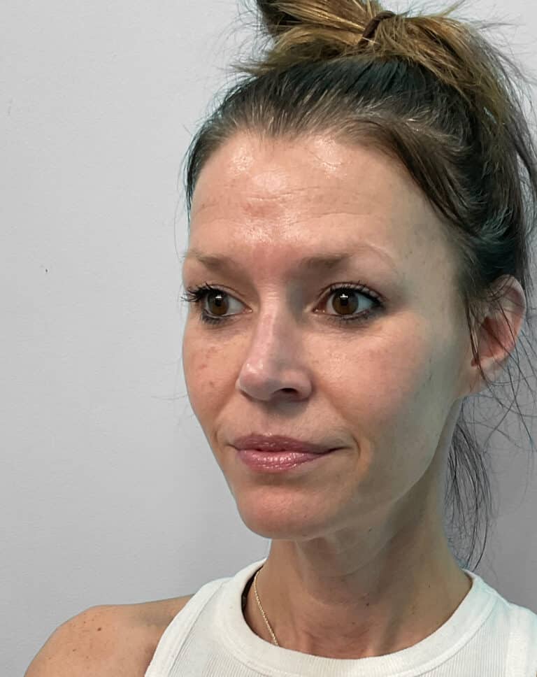 Before Image: Juvéderm Vollure & Botox – Joy - left-front-oblique