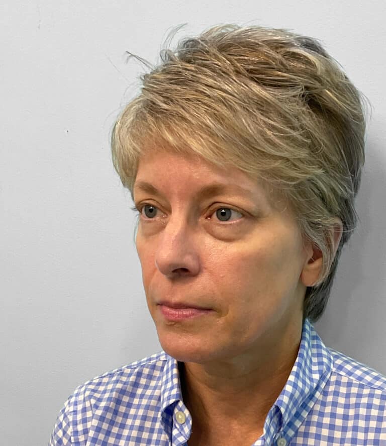 Before Image: Juvéderm Voluma – Joy - left-front-oblique