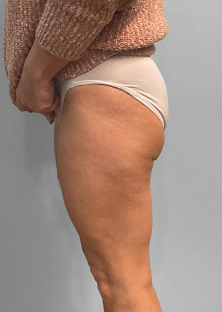 Before Image: Emsculpt Neo – Jessica - left-side