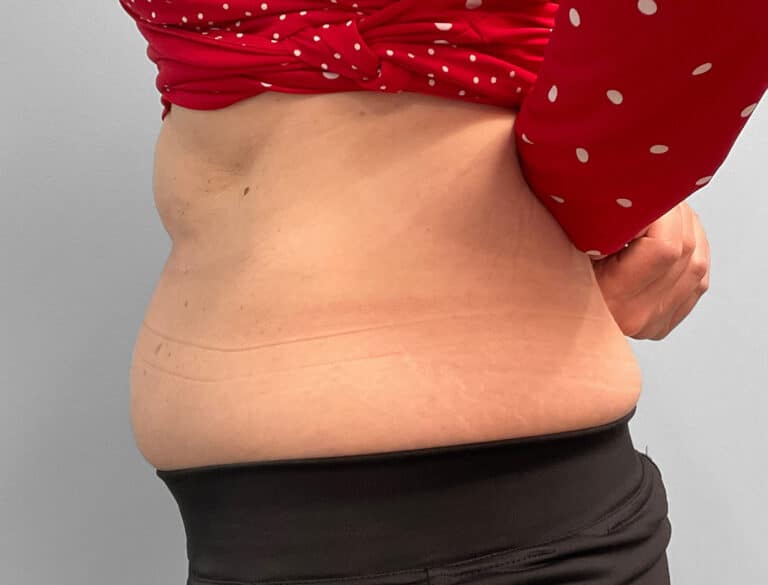 Before Image: Emsculpt Neo – Jessica - left-side