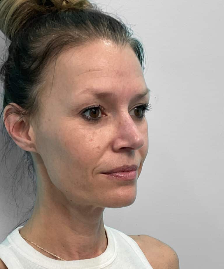 Before Image: Juvéderm Vollure & Botox – Joy - right-front-oblique