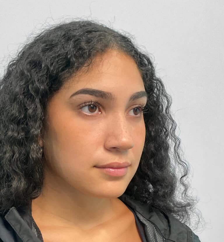 Before Image: Juvéderm Ultra – Joy - right-front-oblique