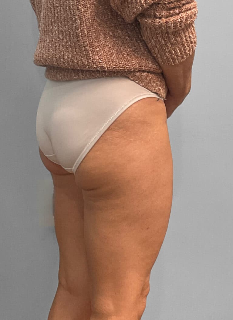 Before Image: Emsculpt Neo – Jessica - right-back-oblique