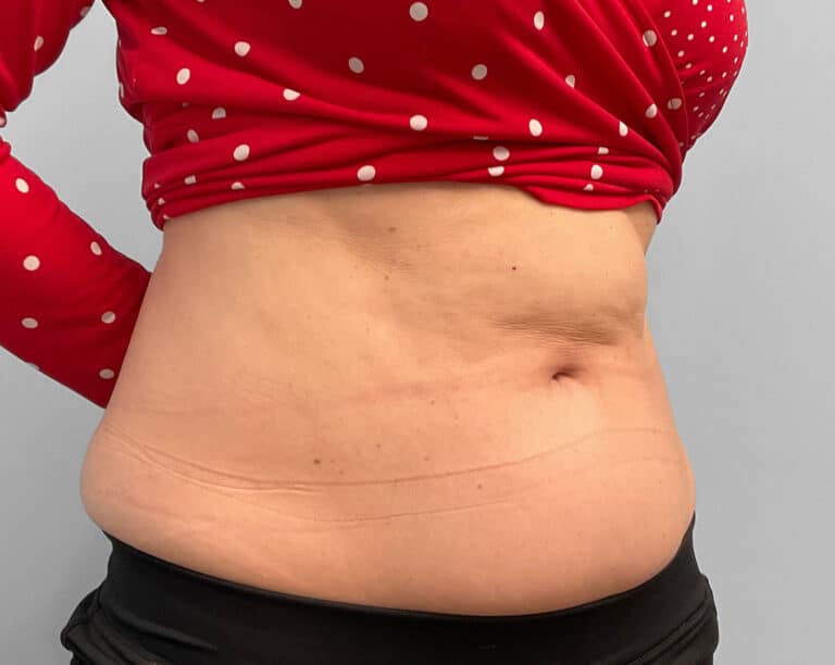 Before Image: Emsculpt Neo – Jessica - right-front-oblique